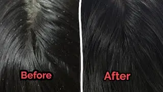 Nits and lice treatment Tamil #vinscaretamil#nits#lice#pen#eer#  பேன்#ஈர்# haircare#scalpcare