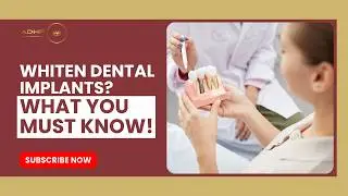 How to Whiten Dental Implants at Home 🦷 ADHP