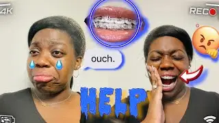 BRACES UPDATE| BRACKET&POKEY WIRE CAME OFF IN SLEEP IN 24hrs 🤬|WHAT SHOULD I DO?🥺|Styy Summer 2022