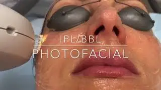 IPL/BBL Photofacial | Dr. Frank Fechner