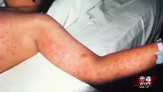 South Carolina measles outbreak: Jan. 19 Update