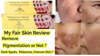 My Fair Cream Review Pigmentation, Dark Spots,Malasma ll Beauty Sight ll