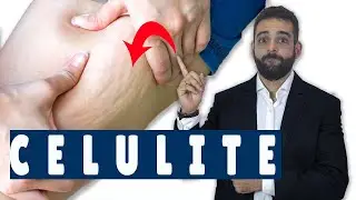 CELULITE -  Causas e Tratamentos - Como Evitar?