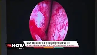 New procedure at UH offers alternative to medication and invasive prostate surgery