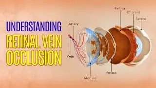 Understanding Retinal Vein Occlusion (RVO)