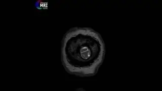 Multiparametric MRI in 52 years old patient with large brain tumor