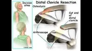 Distal Clavicle Excision Surgery Or Mumford Procedure ; Definition, Purpose, Benefits