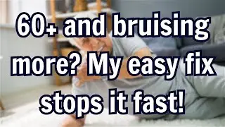 Why Bruising Worsens After 60 &ndash; 5 Easy Fixes!