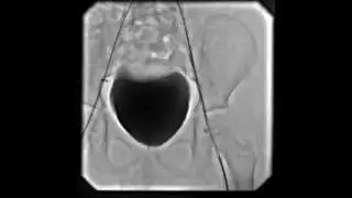 Final retrieval of intravascular foreign body