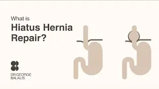Dr George Balalis | What is hiatus hernia repair?
