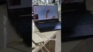 DIGITAL INTRAORAL  SCANNING FOR CROWN AND BRIDGES AT GILLORE DENTAL INDORE