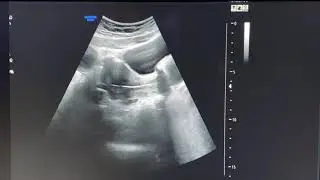 FERTILITE  Transfert d&rsquo;un embryon &agrave; J3 post ponction FIV &agrave; la clinique INAYA de Fertilit&eacute; Casablanca