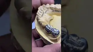 Metal work #dentist #smiledesigndental #youtubeshorts #satisfying #dentalprosthesis #shortsviral