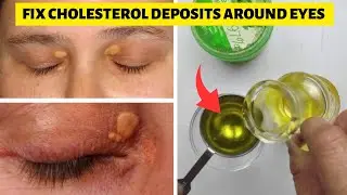 How To Remove Cholesterol Deposits Around Eyes Naturally   Xanthelasma Removal At Home