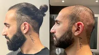 Why I&rsquo;m Bald After Two Hair Transplants
