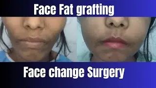 Face change after plastic surgery| Facial fat grafting| Facial fat grafting in Ranchi #facechange 
