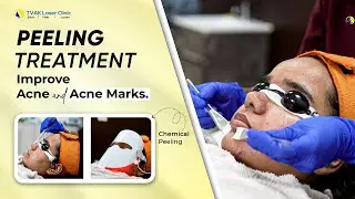Acne Treatment: Chemical Peeling  for Pimples and Darkspots | Best Dermatologist Delhi | Dr Jaishree