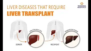 Liver Transplant Cost in Hyderabad, India | Liver Diseases That Require Liver Transplant