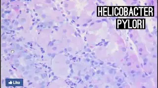 Helicobacter Pylori