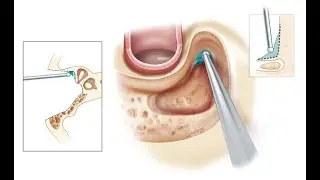 MASTOIDECTOMY - INTRODUCTION | MASTOIDITIS | CLASSIFICATIONS | SURGICAL PROCEDURE