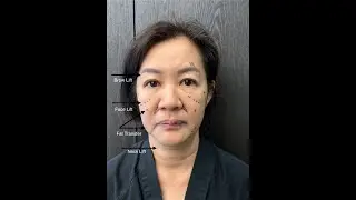 I had a face lift in Korea | Before & After, Healing Process, Recovery & Results