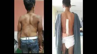 scoliosis surgery in Grande International Hospital