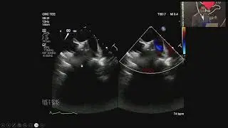 Echo Chandigarh 2025: 9 Evaluation of Atrial Septal Defect ASD By Dr Jesu Krupa