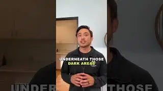 Is dark cupping marks bad?😱　#chiropractic #chiro #cupping #shorts