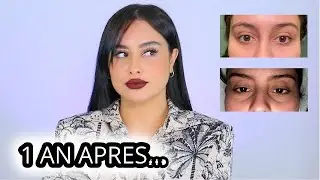 INJECTIONS CERNES : Résultat 1 an après !!!