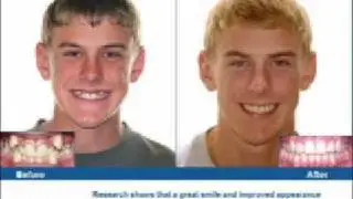 Damon Braces with no extraction