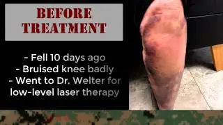 Episode 1b : Dr. Chad Welter uses the Litecure Laser to reduce pain and promote healing