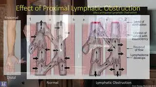 &ldquo;Retinoic Acid therapy mitigates post-surgical lymphedema&rdquo; Alex Wong, M.D., F.A.C.S.