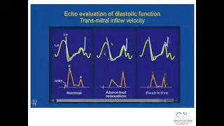Episode 5: Diastolic LV function