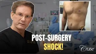 Gynecomastia Post Surgery Complications - Seroma