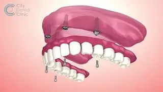 All on 4 dental implants - English