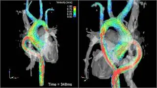 Whole heart 4D flow MRI   3D blood flow visualization in a patient with aortic bypass 1ORpeB6j0gc