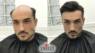 Impianto Capillare in micropelle adesiva per risoluzione alopecia maschile