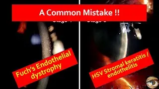 A common mistake : Fuch's dystrophy or Viral keratitis - Dr. Vaibhav Nagpal