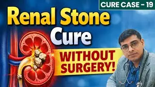 Renal Stone Cure Without Surgery | Renal Stone Cure Case No 19 | Dr Abhik Ghosh Homeopathy