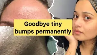 Magical herbs that remove tiny bumps & acne 🌿 ✅| best organic herbs for acne prevention 💯💁🏼&zwj;♀️#yt