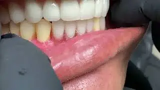 Trying in the patient's mouth