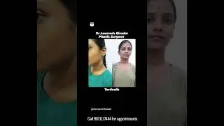Torticolis  correction | Dr Amaresh Biradar Plastic Surgeon Kalaburagi Karnataka