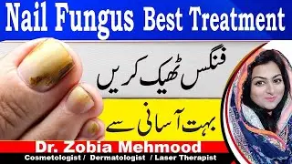 Toe Nail Fungus Causes,Symptoms And Treatment In Urdu