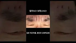 미간주름 영구교정  언제 필요할까? #미간필러부작용 #관상성형 #미간보톡스 #신촌성형외과 #60대성형