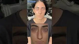 Deviated Septum & Dorsal Hump Corrected | Rhinoplasty Surgery Patient Experience | Before & After