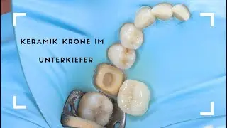 Zahnarzt Keramik Krone mit Kofferdam - Crown Preparation with rubber dam