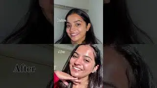 #ytshorts #skincare #darkspots #acne #marks #acnemarks #skincareroutine #glassskin #pigmentation