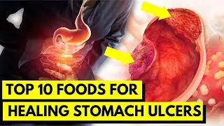 Top 10 Foods to Heal Your Stomach Ulcer Naturally | Natural Remedies for Peptic Ulcers