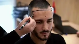 Trapianto Capelli in Albania - Albania Hair Clinic 🇦🇱🇮🇹