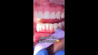 Что будет, если поставить брекеты во второй раз? Стоматология Tooth Time Family, Нью-Браунфелс, Т...
